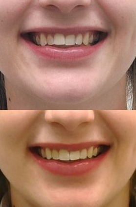 잠실교정치과 유펜바른치과의 인비절라인익스프레스가 특별한 이유 (5개월 인비절라인급속교정 잠실인비절라인 송파인비절라인 인비절라앞니부분교정) 관련 이미지 3