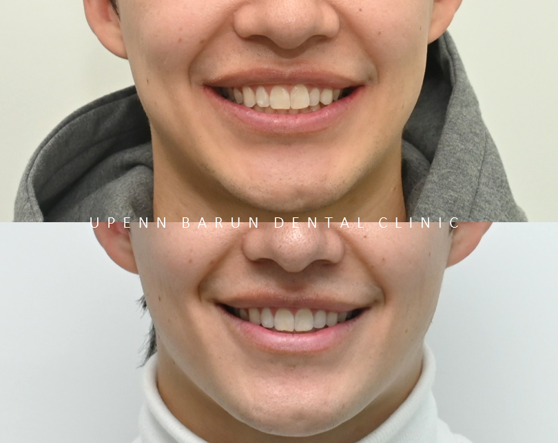 인비절라인을 시작할때 고려해야 하는 세가지 조건 (인비절라인다이아몬드 다이아몬드등급치과 인비절라인앞니교정 앞니급속교정 비발치교정 치간삭제 치간삭제양) 관련 이미지 5