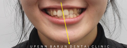 안면비대칭, 잠실수술교정, 잠실양악수술도 유펜바른치과입니다. 관련 이미지 4