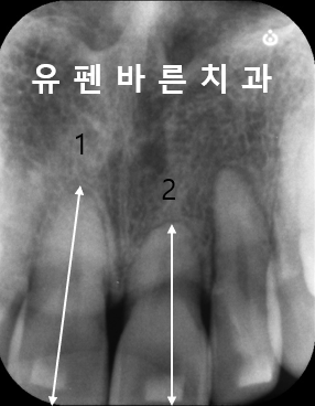 인비절라인으로 재교정, 가능할까용?? 관련 이미지 5