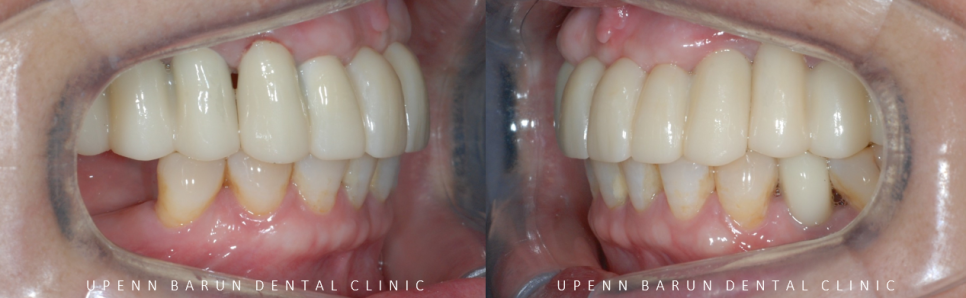 잠실새내역임플란트 잠실새내역치과 유펜바른치과에서 전체임플란트치료 ( 잠실임플란트후기 임플란트기간  전체임플란트) 관련 이미지 14