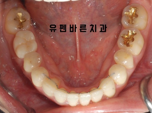 앞니부분교정 잠실인비절라인 라이트 옵션 들어보셨나요? 관련 이미지 6