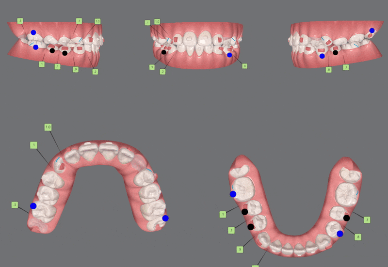 다이아몬드등급치과에서 인비절라인퍼스트로 반대교합 해결! 1차, 2차교정을 한번에!( 어린이반대교합 송파인비절라인퍼스트 잠실엘스상가교정치과 잠실인비절라인퍼스트 인비절라인스피커치과) 관련 이미지 15