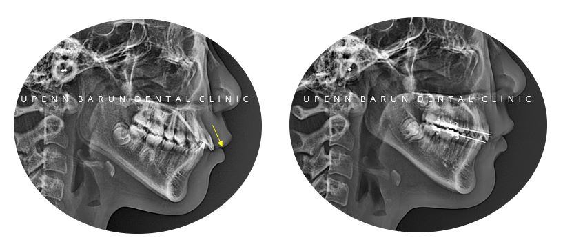 잠실새내역청소년교정 잠실돌출입발치교정은 유펜바른치과!(잠실중학생발치교정 잠실무턱교정 잠실새내소아교정치과 잠실새내교정잘하는치과 발치교정외모변화) 관련 이미지 5