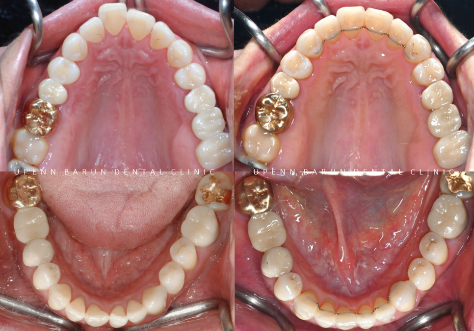 인비절라인 공식 스피커가 상주하고 치료하는 송파교정잘하는치과 유펜바른치과 (잠실성인교정 잠실재교정 잠실인비절라인 성인인비절라인교정 잠실나루역교정치과 문정동교정치과 삼전역교정치과) 관련 이미지 18