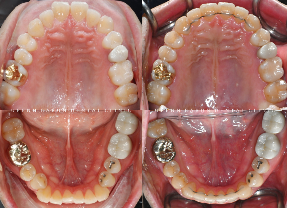 주걱턱 반대교합도 잠실인비절라인 잠실교정치과 유펜바른치과에서!(비발치주걱턱교정 잠실성인교정 반대교합인비절라인 잠실교정치과 주걱턱교정후기) 관련 이미지 24