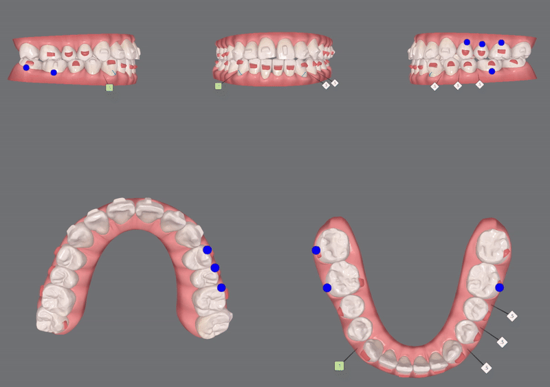 송파인비절라인다이아몬드등급 치과에서 악궁확장장치 없이 반대교합 해결한 후기(인비절라인높은등급 인비절라인반대교합 인비절라인비발치교정 인비절라인잘하는치과 인비절라인교정전문) 관련 이미지 10