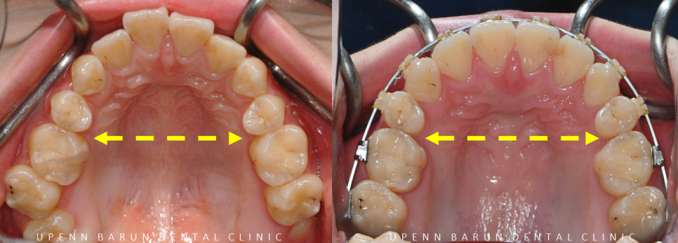 반대교합+개방교합 비수술교정 유펜바른치과에서 재교정한 후기! ( 비발치개방교합 비발치반대교합 재교정후기 잠실교정치과 미니스크류비수술교정 악궁확장장치 MARPE) 관련 이미지 9