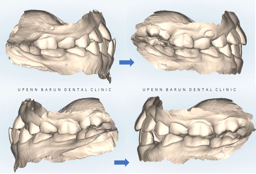 8세 어린이반대교합 인비절라인퍼스트로 수월하게 해결 후기! 잠실인비절라인퍼스트 잠실인비절라인소아교정 (잠실교정치과 잠실인비절라인 인비절라인등급 인비절라인후기 잠실소아교정) 관련 이미지 16