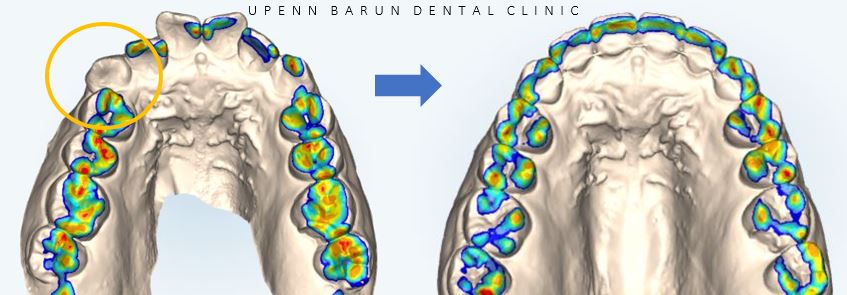 유학생치아교정 유학생교정치과 잠실교정치과 잠실데이몬교정 데이몬클리어교정 Wide Smile (송파교정치과 잠실새내교정치과 강동교정치과 헬리오시티교정치과 예쁜미소 Smile Arc) 관련 이미지 14