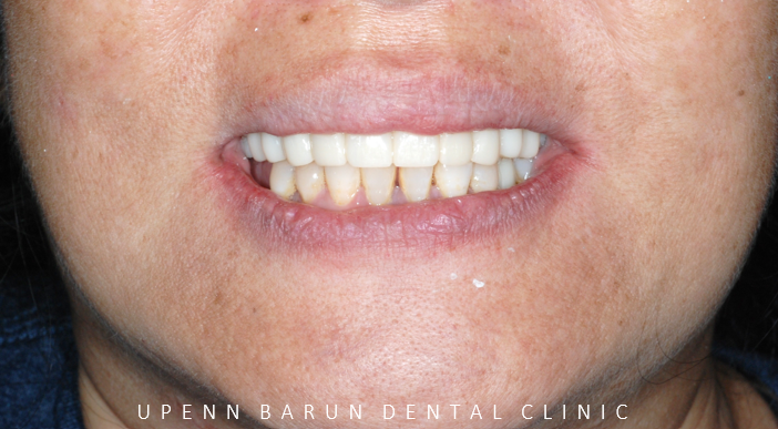 잠실새내역임플란트 잠실새내역치과 유펜바른치과에서 전체임플란트치료 ( 잠실임플란트후기 임플란트기간  전체임플란트) 관련 이미지 15