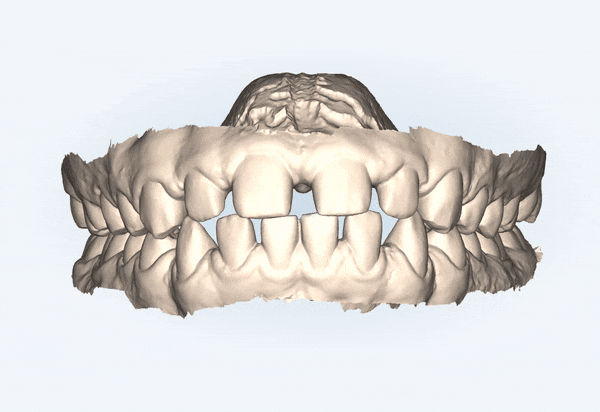 인비절라인높은등급 인비절라인플래티넘엘리트 잠실교정치과 잠실인비절라인 (잠실교정치과 송파인비절라인 인비절라인전후사진 인비절라인후기) 관련 이미지 3