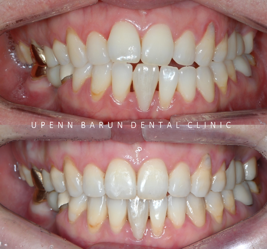 인비절라인 공식 스피커가 상주하고 치료하는 송파교정잘하는치과 유펜바른치과 (잠실성인교정 잠실재교정 잠실인비절라인 성인인비절라인교정 잠실나루역교정치과 문정동교정치과 삼전역교정치과) 관련 이미지 3