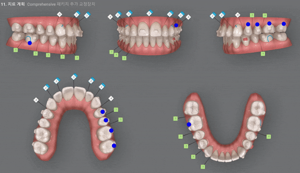 개방교합은 교정용 미니스크류 쓰지말고 인비절라인만으로 쉽게 해결하세요! (잠실인비절라인  잠실새내인비절라인  개방교합교정  잠실새내교정치과) 관련 이미지 13