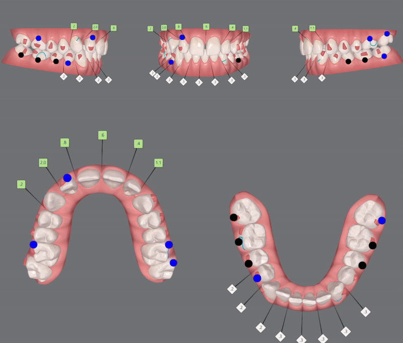 '옥니같이 보여요' 인비절라인급속교정 가능할까? with 캐리에모션장치 (잠실다이아몬드등급 인비절라인다이아몬드등급 서울다이아몬드등급치과 옥니인비절라인후기) 관련 이미지 9