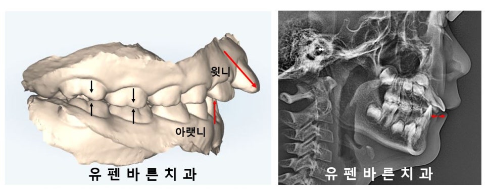 저도 친구들이 많이 하는 인비절라인교정 하고싶어요! 관련 이미지 2