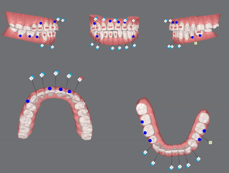 평생 삐뚤어진 치아가 고민이셨던 79세 고령환자분이 선택한 송파인비절라인다이아몬드등급 후기 (서울인비절라인전문치과 잠실인비절라인교정치과 노인교정 노인치아교정 노인교정치과) 관련 이미지 15