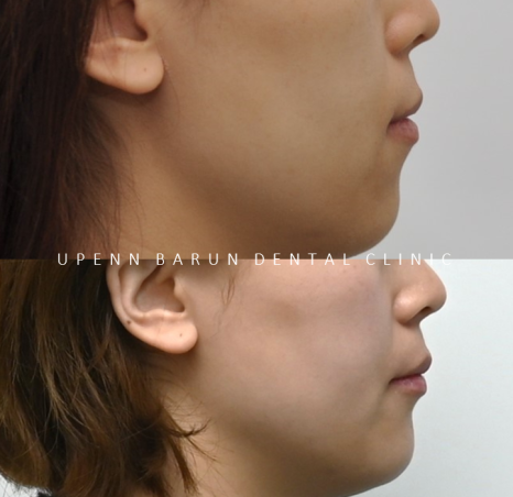 잇몸웃음 거미스마일(gummy smile) 교정후 입동굴 예쁜미소로!(잠실교정치과 거미스마일교정후기 거미스마일교정전후 클라리티세라믹교정 미니스크류교정 미국치과교정과전문의) 관련 이미지 12