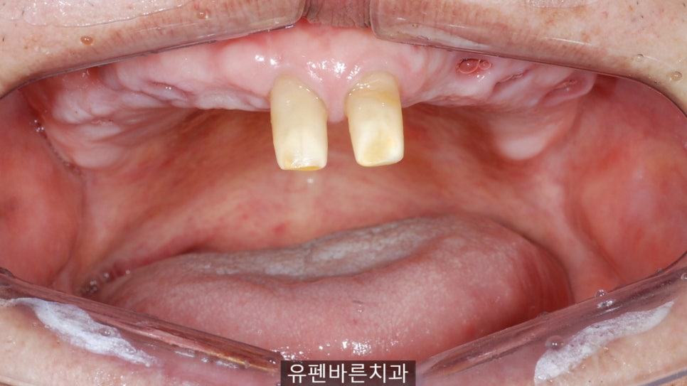 연세가 엄청 많으신데도 전체 임플란트 수술이 가능하다구요? 관련 이미지 2