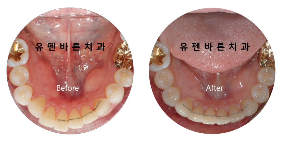 인비절라인으로 재교정, 가능할까용?? 관련 이미지 8