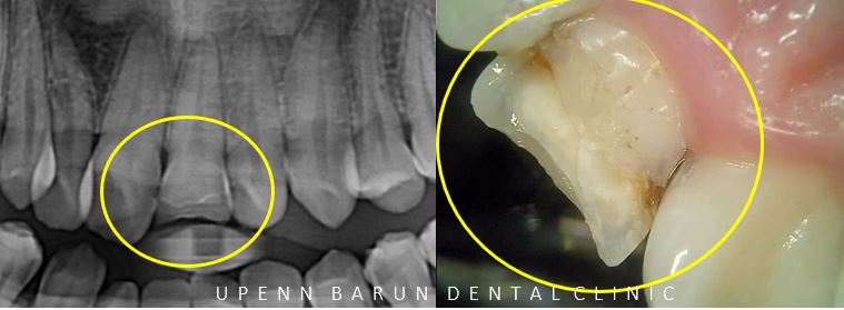 잠실데이몬교정, 비발치교정, 잠실덧니교정 (AKA Damon Smile) 관련 이미지 4