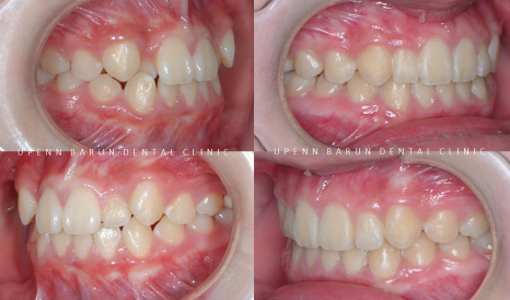 2024년 송파구 단일 치과의원급 중 유일!!! 인비절라인다이아몬드등급 달성한 유펜바른치과의 청소년인비절라인 후기 (청소년반대교합 어린이반대교합 잠실인비절라인잘하는치과) 관련 이미지 18