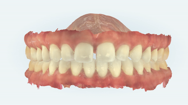 앞니벌어짐 인비절라인익스프레스로 해결하기 (인비절라인앞니부분교정 인비절라인재교정 송파인비절라인 잠실인비절라인 잠실교정치과 인비절라인익스프레스비용) 관련 이미지 2