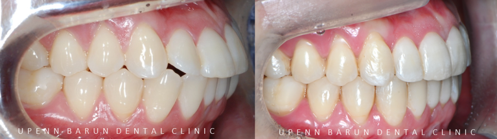 "치아가 앞으로 뻐드러졌어요!" 송파인비절라인다이아몬드등급치과에서!!(비발치인비절라인 뻐드렁니교정치과 돌출입교정치과) 관련 이미지 13