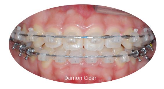 유학생치아교정 유학생교정치과 잠실교정치과 잠실데이몬교정 데이몬클리어교정 Wide Smile (송파교정치과 잠실새내교정치과 강동교정치과 헬리오시티교정치과 예쁜미소 Smile Arc) 관련 이미지 7