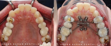 ABO 미국 치과교정과 전문의의 비수술치아교정 악궁확장장치 후기 (잠실교정전후 잠실새내교정치과 잠실교정치과 교정통증  앞니 변화) 관련 이미지 3