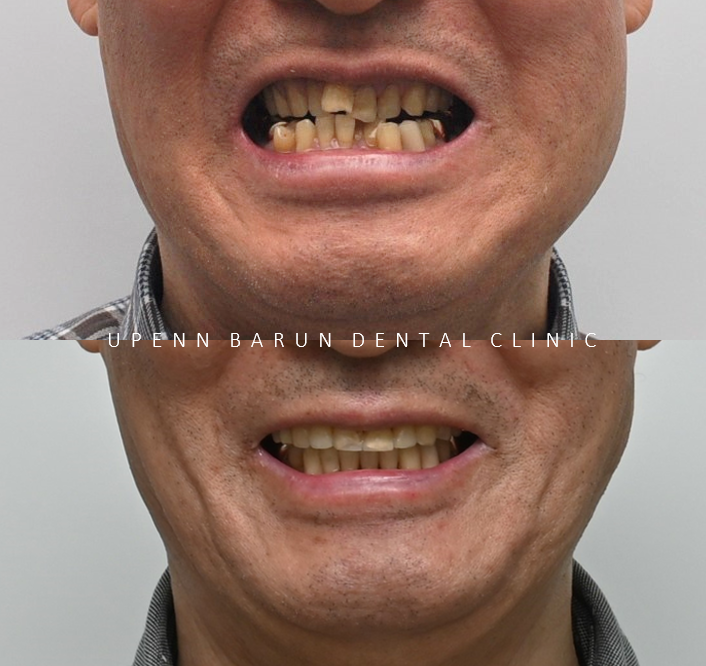 평생 삐뚤어진 치아가 고민이셨던 79세 고령환자분이 선택한 송파인비절라인다이아몬드등급 후기 (서울인비절라인전문치과 잠실인비절라인교정치과 노인교정 노인치아교정 노인교정치과) 관련 이미지 4