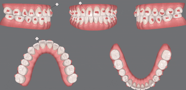 나스닥에 상장한 인비절라인, 잠실투명교정 잠실인비절라인 후기와 치아미백이 궁금하다면? 관련 이미지 13
