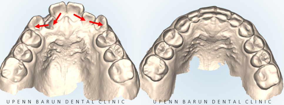 2024년 송파구 단일 치과의원급 중 유일!!! 인비절라인다이아몬드등급 달성한 유펜바른치과의 청소년인비절라인 후기 (청소년반대교합 어린이반대교합 잠실인비절라인잘하는치과) 관련 이미지 8