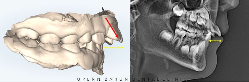 유독 튀어나와 다치기 쉬운 앞니! INVISALIGN FIRST로 8개월만에 끝낸 후기 (송파인비절라인소아교정 인비절라인1차교정 송파인비절라인퍼스트  송파인비절라인어린이교정) 관련 이미지 7