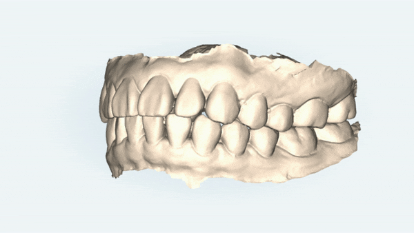 20대 여성 앞니 사이 틈 2개월만에 해결 (인비절라인익스프레스 INVISALIGN EXPRESS 인비절라인후기 잠실인비절라인  잠실투명교정치과) 관련 이미지 3