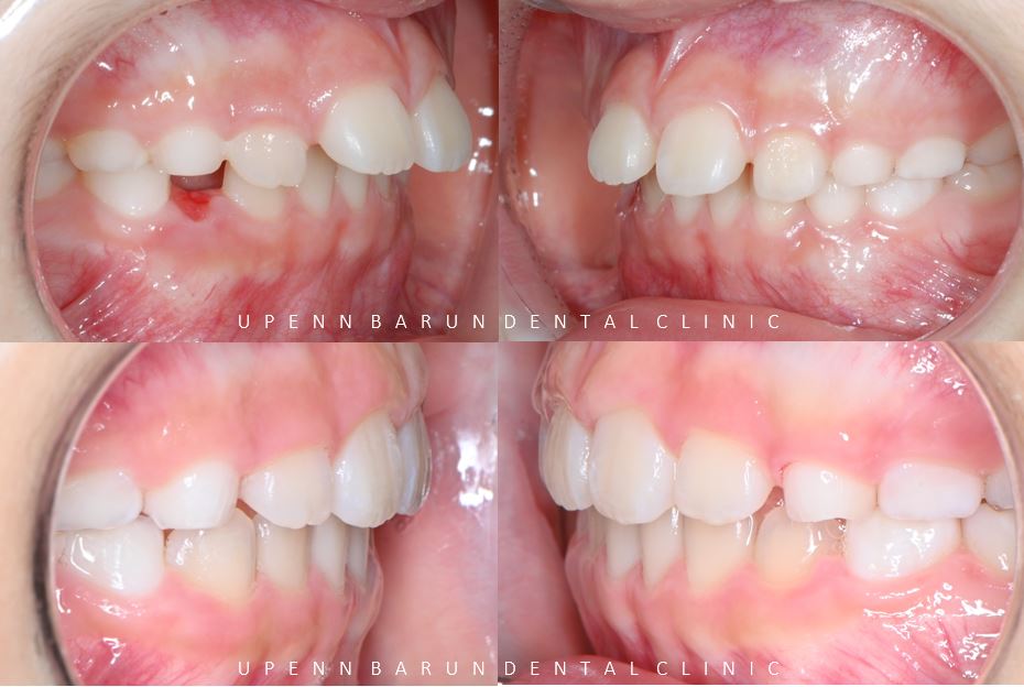 유독 튀어나와 다치기 쉬운 앞니! INVISALIGN FIRST로 8개월만에 끝낸 후기 (송파인비절라인소아교정 인비절라인1차교정 송파인비절라인퍼스트  송파인비절라인어린이교정) 관련 이미지 3