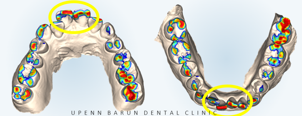 송파인비절라인다이아몬드등급 치과에서 악궁확장장치 없이 반대교합 해결한 후기(인비절라인높은등급 인비절라인반대교합 인비절라인비발치교정 인비절라인잘하는치과 인비절라인교정전문) 관련 이미지 4