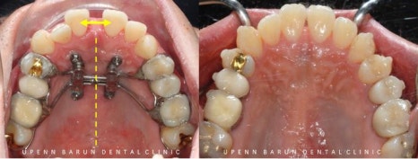 ABO 미국 치과교정과 전문의의 비수술치아교정 악궁확장장치 후기 (잠실교정전후 잠실새내교정치과 잠실교정치과 교정통증  앞니 변화) 관련 이미지 4