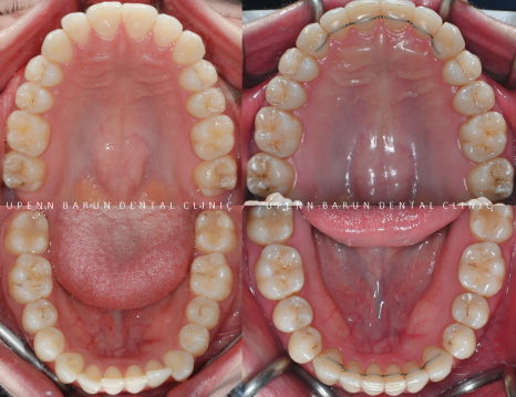 "치아가 앞으로 뻐드러졌어요!" 송파인비절라인다이아몬드등급치과에서!!(비발치인비절라인 뻐드렁니교정치과 돌출입교정치과) 관련 이미지 14