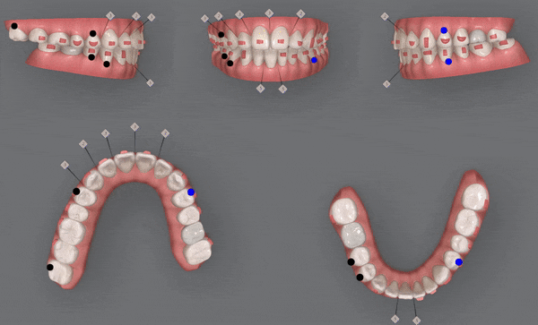 인비절라인 공식 스피커가 상주하고 치료하는 송파교정잘하는치과 유펜바른치과 (잠실성인교정 잠실재교정 잠실인비절라인 성인인비절라인교정 잠실나루역교정치과 문정동교정치과 삼전역교정치과) 관련 이미지 7