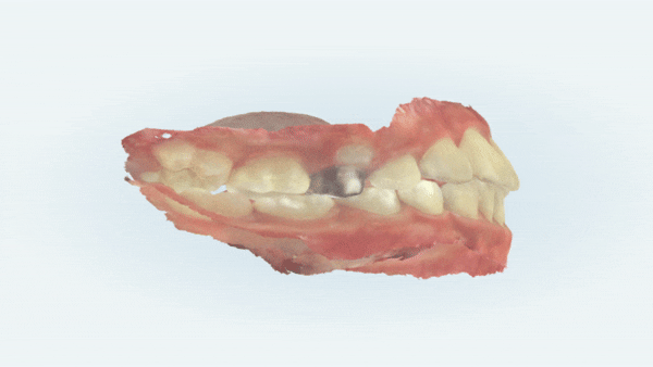 8세 어린이반대교합 인비절라인퍼스트로 수월하게 해결 후기! 잠실인비절라인퍼스트 잠실인비절라인소아교정 (잠실교정치과 잠실인비절라인 인비절라인등급 인비절라인후기 잠실소아교정) 관련 이미지 18