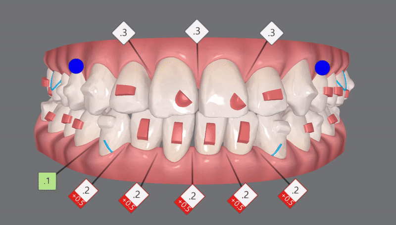 송파인비절라인다이아몬드등급 치과에서 악궁확장장치 없이 반대교합 해결한 후기(인비절라인높은등급 인비절라인반대교합 인비절라인비발치교정 인비절라인잘하는치과 인비절라인교정전문) 관련 이미지 11