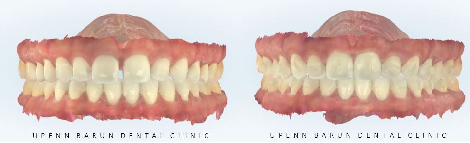 앞니벌어짐 인비절라인익스프레스로 해결하기 (인비절라인앞니부분교정 인비절라인재교정 송파인비절라인 잠실인비절라인 잠실교정치과 인비절라인익스프레스비용) 관련 이미지 9