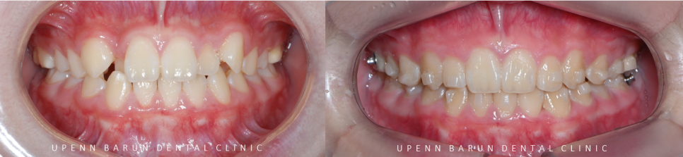 2024년 송파구 단일 치과의원급 중 유일!!! 인비절라인다이아몬드등급 달성한 유펜바른치과의 청소년인비절라인 후기 (청소년반대교합 어린이반대교합 잠실인비절라인잘하는치과) 관련 이미지 14