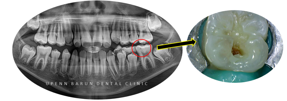 송파인비절라인다이아몬드등급치과 에서 인비절라인으로 1차 2차 교정을 한번에! (송파인비절라인퍼스트 잠실어린이인비절라인 인비절라인소아교정 잠실소아교정 어린이반대교합) 관련 이미지 9