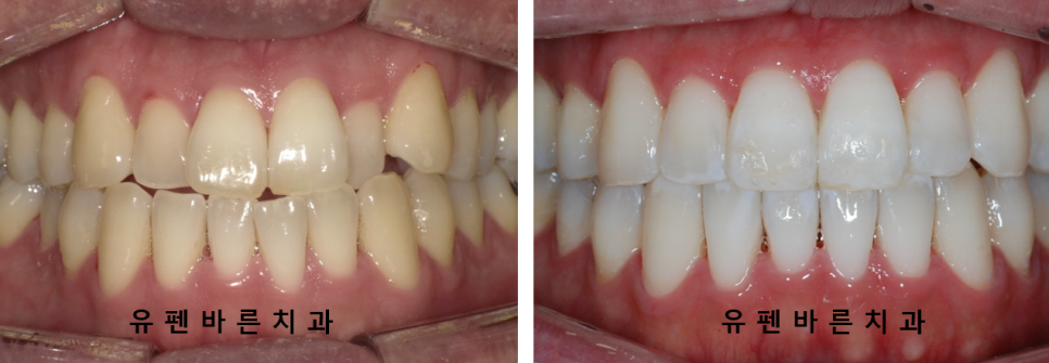 나스닥에 상장한 인비절라인, 잠실투명교정 잠실인비절라인 후기와 치아미백이 궁금하다면? 관련 이미지 4