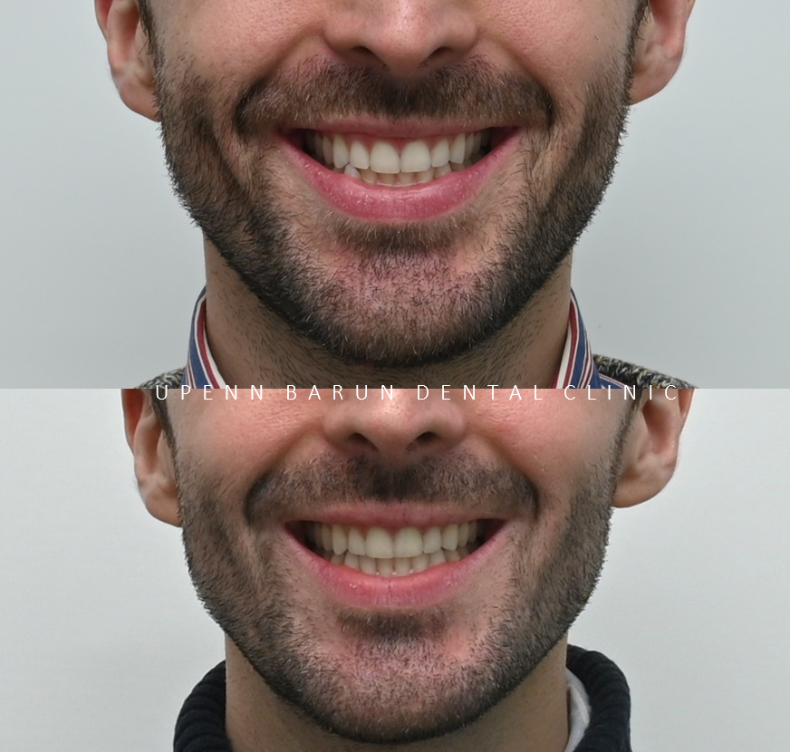 인비절라인다이아몬드등급치과에서 28개의 교정장치로 고민 해결한 후기가 궁금하다면? (잠실송곳니덧니교정 잠실인비절라인 인비절라인교정기간 투명교정장치후기 잠실인비절라인후기) 관련 이미지 14