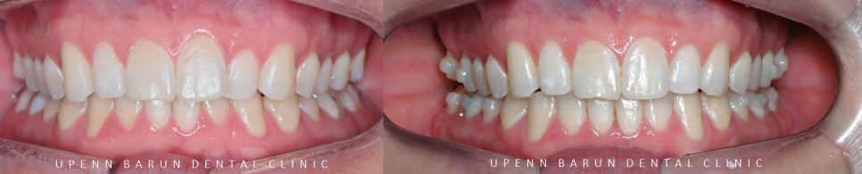 인비절라인을 시작할때 고려해야 하는 세가지 조건 (인비절라인다이아몬드 다이아몬드등급치과 인비절라인앞니교정 앞니급속교정 비발치교정 치간삭제 치간삭제양) 관련 이미지 9