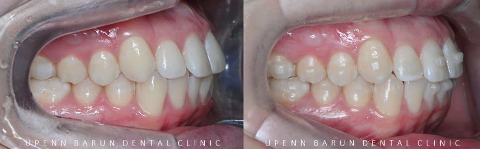가지런했던 앞니가 삐뚤빼뚤해졌어요! 잠실다이아몬드등급 잠실인비절라인 인비절라인익스프레스 앞니 삐뚤어짐 해결(앞니급속교정 앞니투명교정 인비절라인급속교정 인비절라인전후사진) 관련 이미지 8