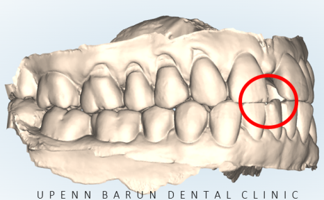 같은원장님께 보철치료와 교정치료를 동시에! 앞니사이 틈 해결한 후기 ( 송파교정치과 잠실교정잘하는치과 송파교정잘하는치과 올림픽파크포레온교정치과 올림픽파크포레온인비절라인치과) 관련 이미지 7